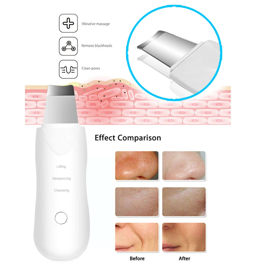 Ultrasonic Facial Spatula — Deep Cleansing and Blackhead Removal